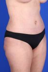 after tummy tuck right angle view of female patient 451 at Paydar Plastic Surgery