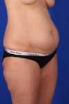 before tummy tuck right angle view of female patient 451 at Paydar Plastic Surgery