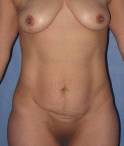 Patient Tummy Tuck Before 0