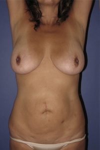 Patient Tummy Tuck Before 0