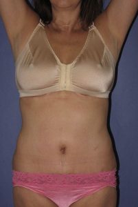 Patient Tummy Tuck After 0