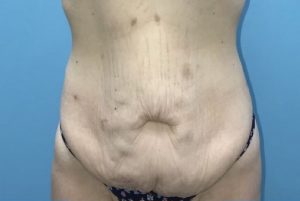 Patient Tummy Tuck Before 0