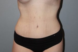 Patient Tummy Tuck After 0