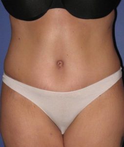 Patient Tummy Tuck After 0