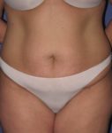 before tummy tuck front view of female patient 486 at Paydar Plastic Surgery