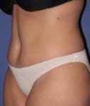 after tummy tuck left angle view of female patient 486 at Paydar Plastic Surgery