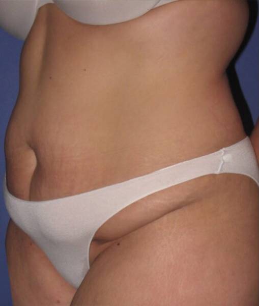 before tummy tuck left angle view of female patient 486 at Paydar Plastic Surgery