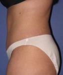 after tummy tuck left side view of female patient 486 at Paydar Plastic Surgery