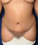 after tummy tuck front view of female patient 529 at Paydar Plastic Surgery