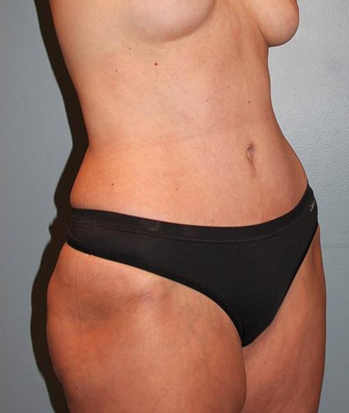 after tummy tuck angle view female patient case 755