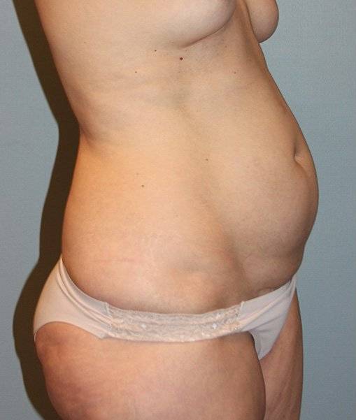 before tummy tuck angle view female patient case 755