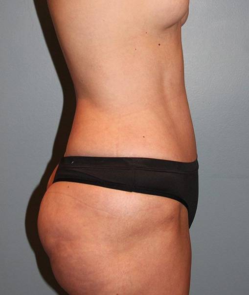 after tummy tuck side view female patient case 755
