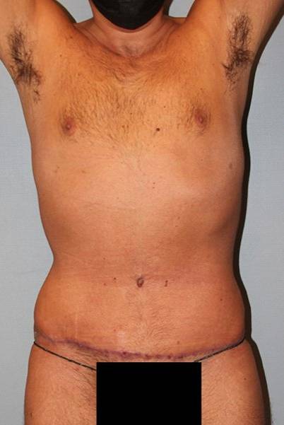 after tummy tuck front view male patient case 864
