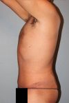 after tummy tuck side view male patient case 864