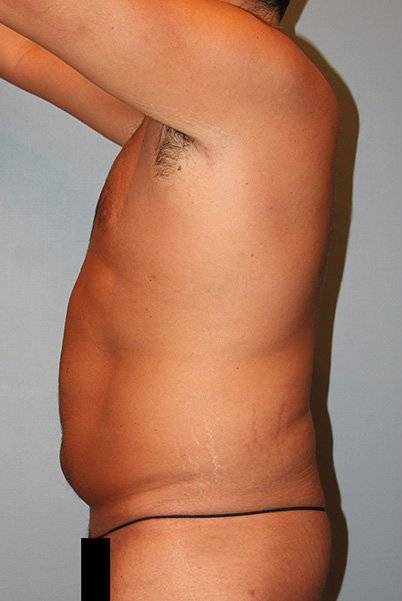 before tummy tuck side view male patient case 864