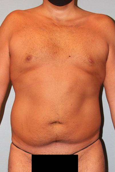 before tummy tuck front view male patient case 854
