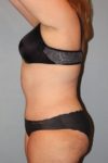 after tummy tuck side view female patient case 910