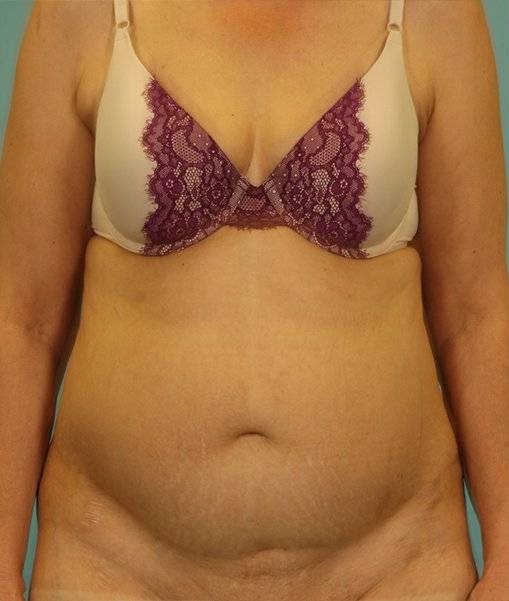 before abdominoplasty front view of female patient 413 at Paydar Plastic Surgery