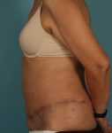 after abdominoplasty left view of female patient 413 at Paydar Plastic Surgery
