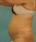 before abdominoplasty left view of female patient 413 at Paydar Plastic Surgery