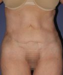 before abdominoplasty front view of female patient 436 at Paydar Plastic Surgery