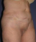 before abdominoplasty right angle view of female patient 436 at Paydar Plastic Surgery