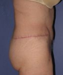 after abdominoplasty right side view of female patient 436 at Paydar Plastic Surgery