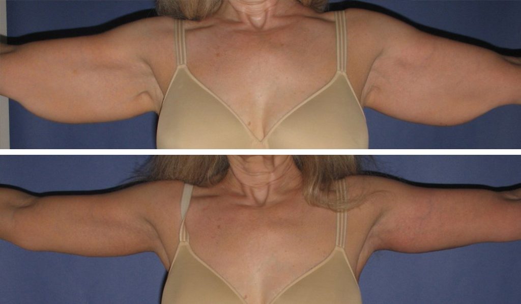 before and after arm lift front view