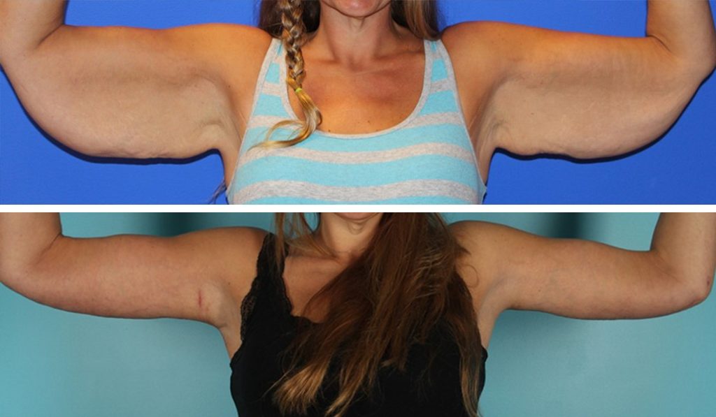 before and after arm lift front view