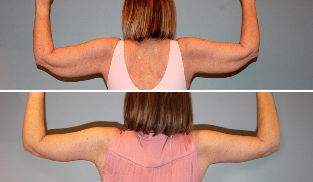 before and after arm lift back view
