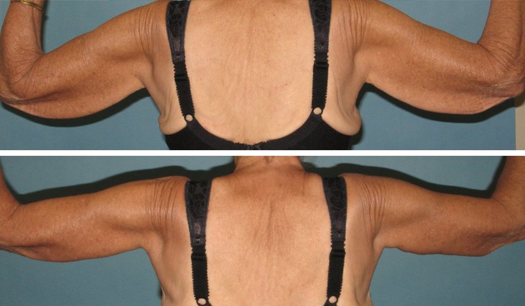 before and after arm lift back view