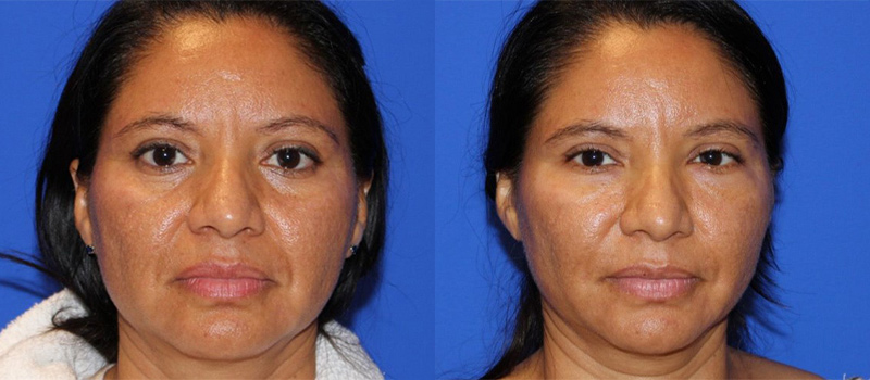 before & after facial fat grafting female patient front view