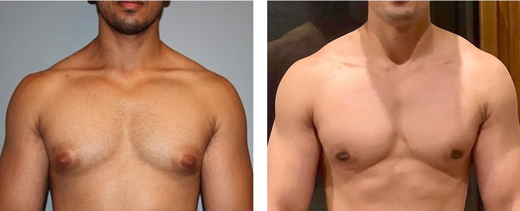 before and after gynecomastia front view