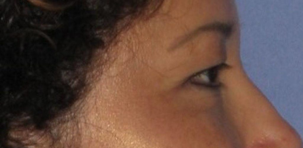 blepharoplasty patient zoomed side profile