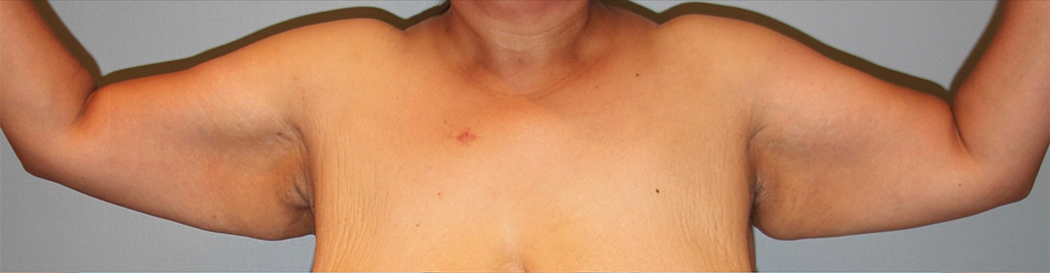 before Brachioplasty / Arm Lift female patient front view Case 3388