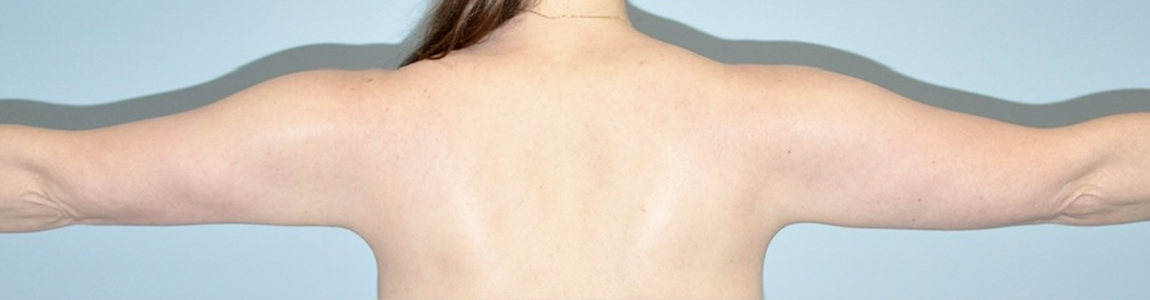 after Brachioplasty / Arm Lift Case female patient back view 3673