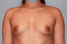 before Breast Augmentation front angle view Case 3467