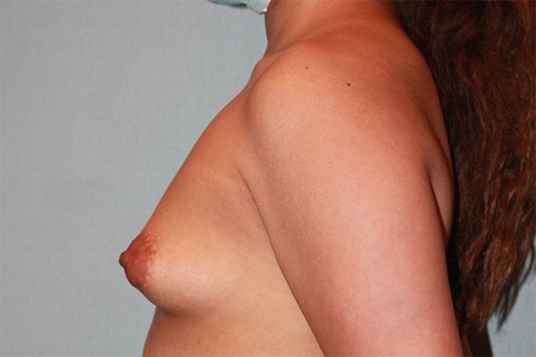 before Breast Augmentation side angle view Case 3467
