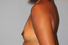 before breast augmentation side view case 3474