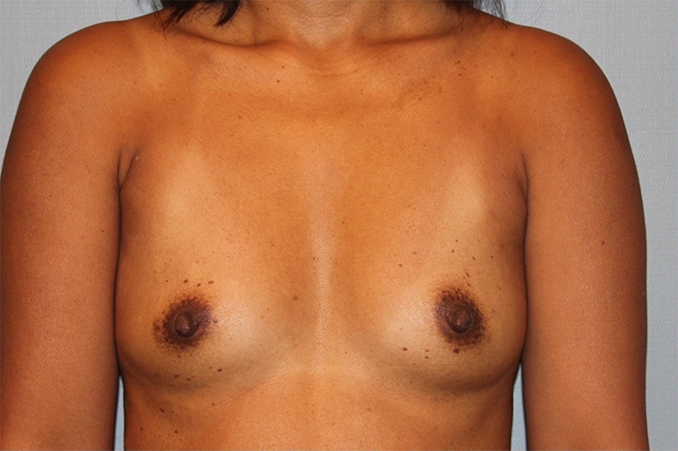 before breast augmentation front view case 3474