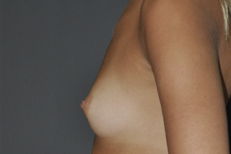before breast augmentation side view case 3481