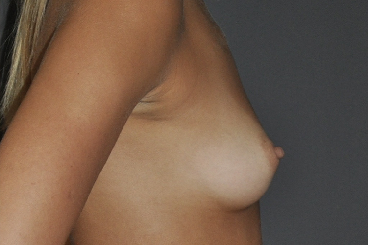 before breast augmentation side view case 3481