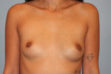 before breast augmentation front view case 3500