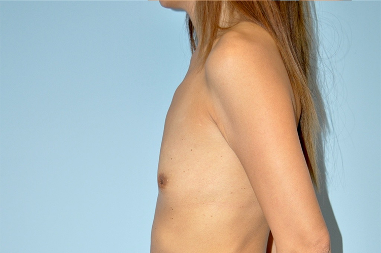 before breast augmentation side view case 3514