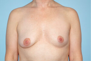 Patient Breast Augmentation Before 0