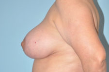 after breast lift and augmentation side view case 3654