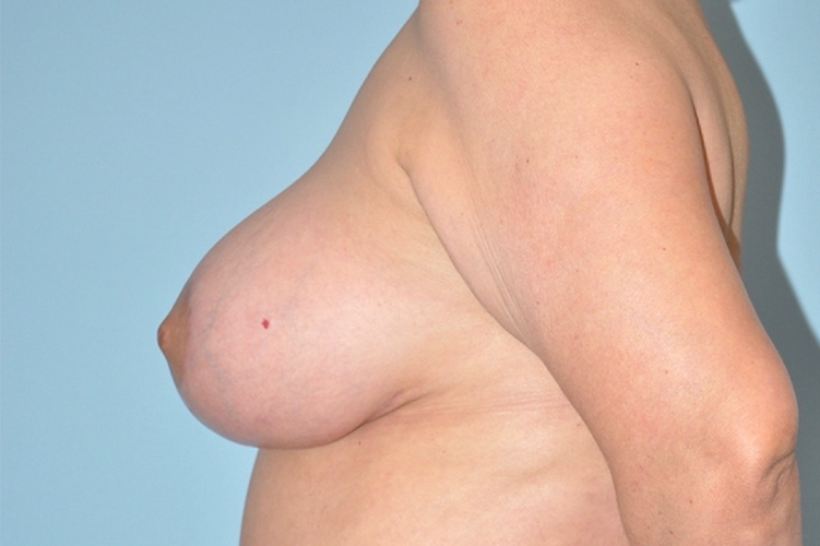 after breast lift and augmentation side view case 3654