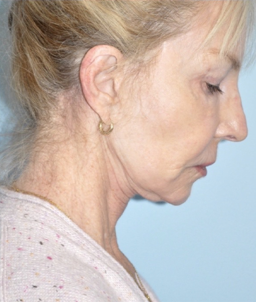 before facelift side view female case 3855