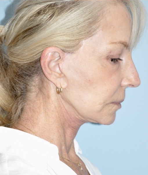 after facelift side view female case 3855