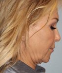 before facelift side view female case 3869